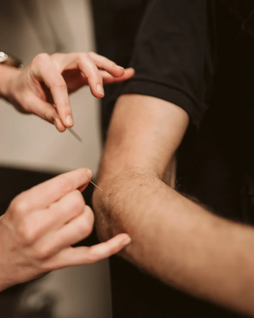 Dry needling behandeling van de onderarm